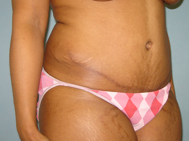 tummy tuck patient