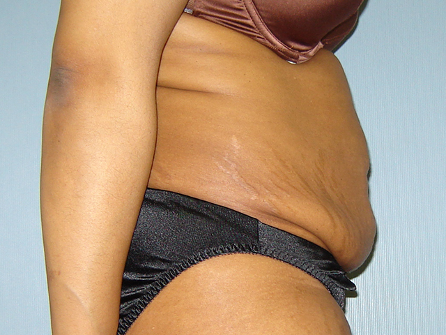 tummy tuck patient