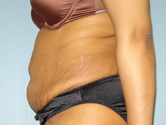tummy tuck patient