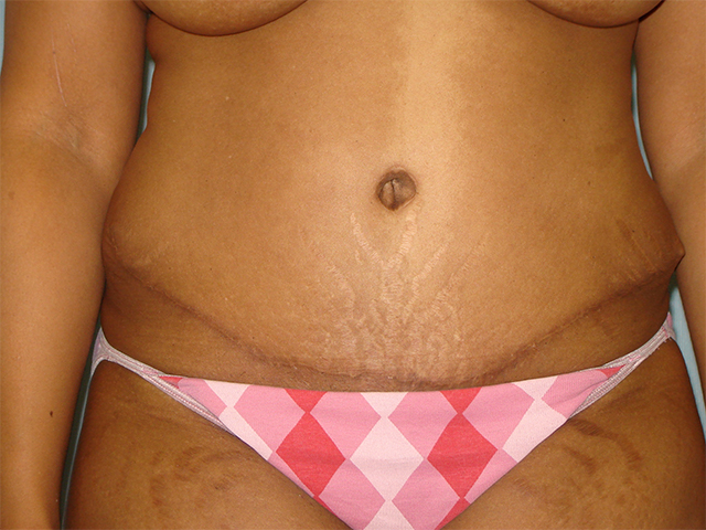 tummy tuck patient