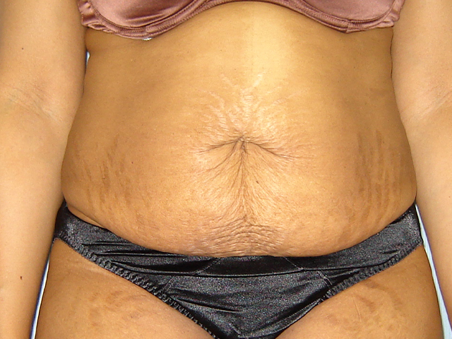 tummy tuck patient