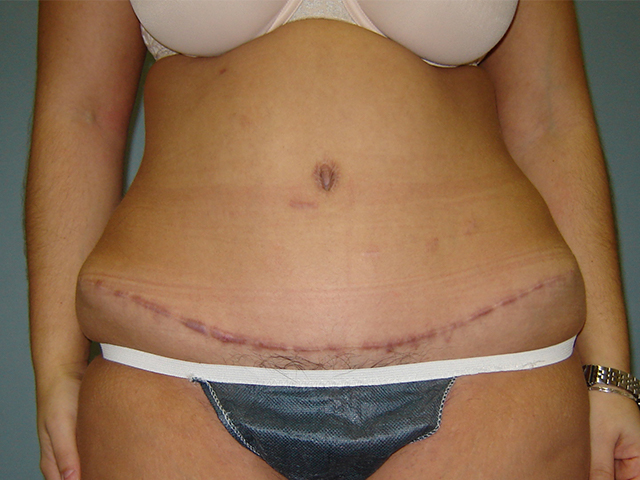tummy tuck patient