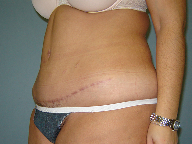 tummy tuck patient