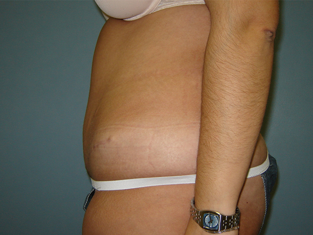 tummy tuck patient