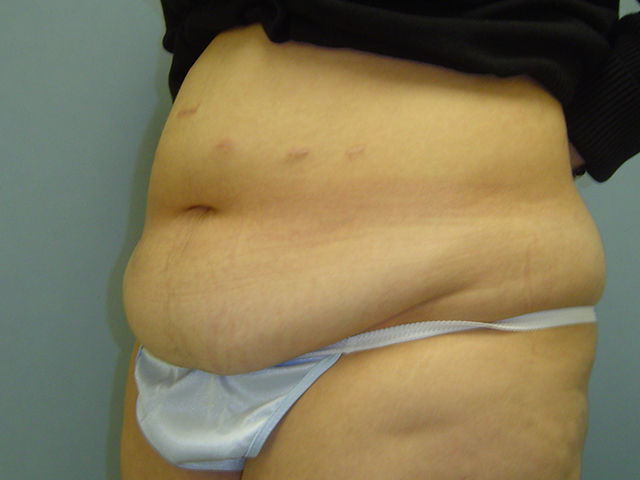tummy tuck patient