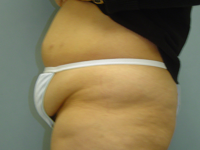 tummy tuck patient