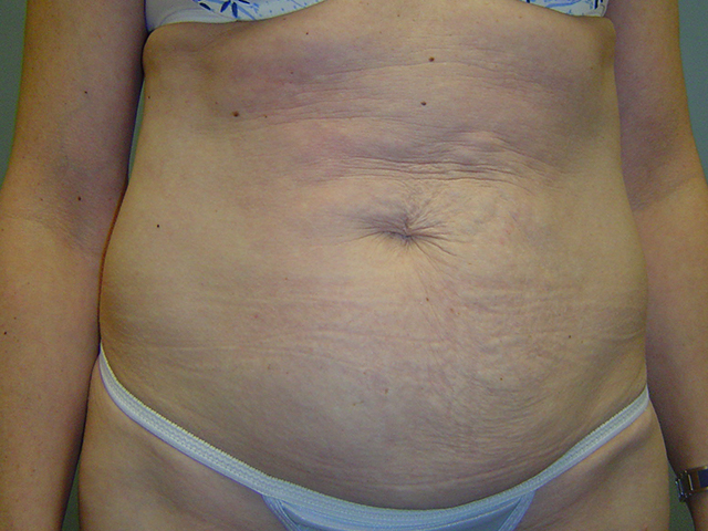 tummy tuck patient