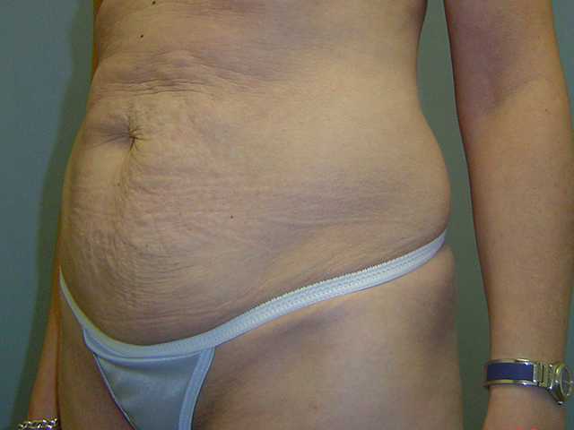 tummy tuck patient