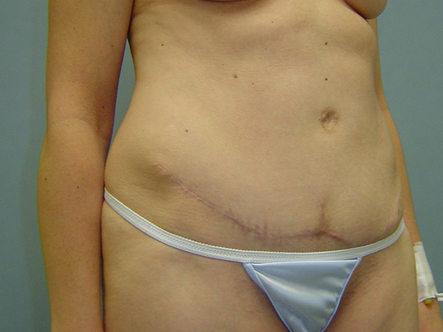tummy tuck patient