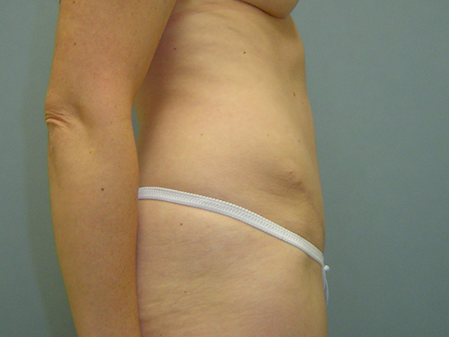 tummy tuck patient