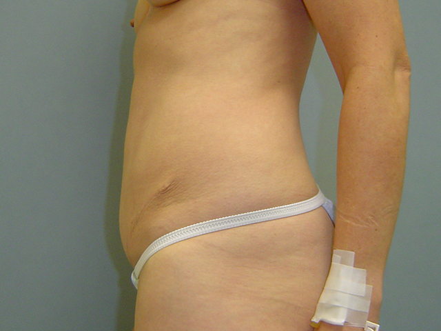 tummy tuck patient