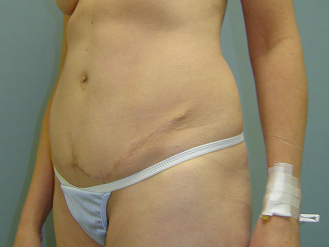 tummy tuck patient