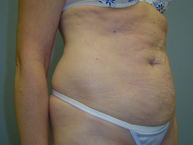 tummy tuck patient