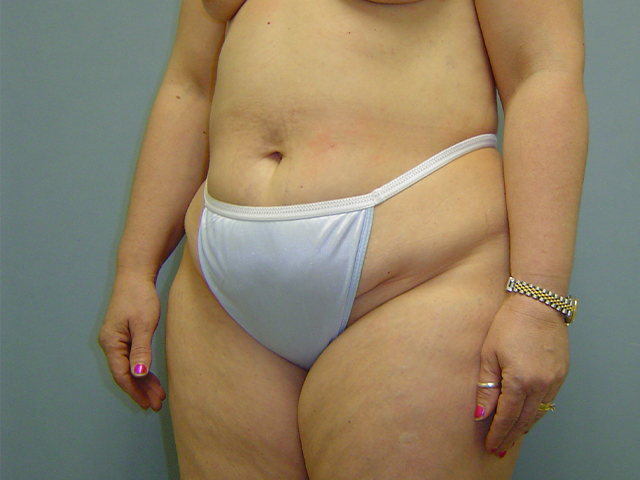 tummy tuck patient