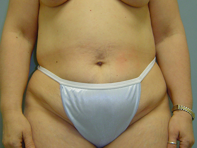 tummy tuck patient