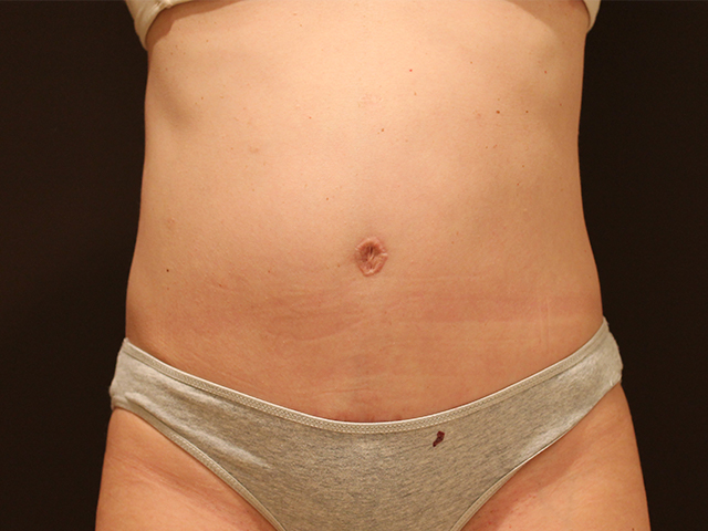 tummy tuck patient