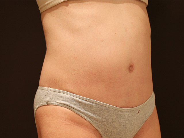 tummy tuck patient