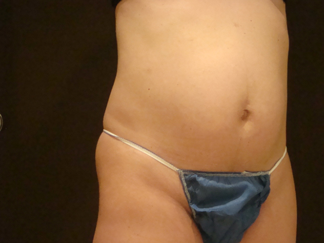 tummy tuck patient