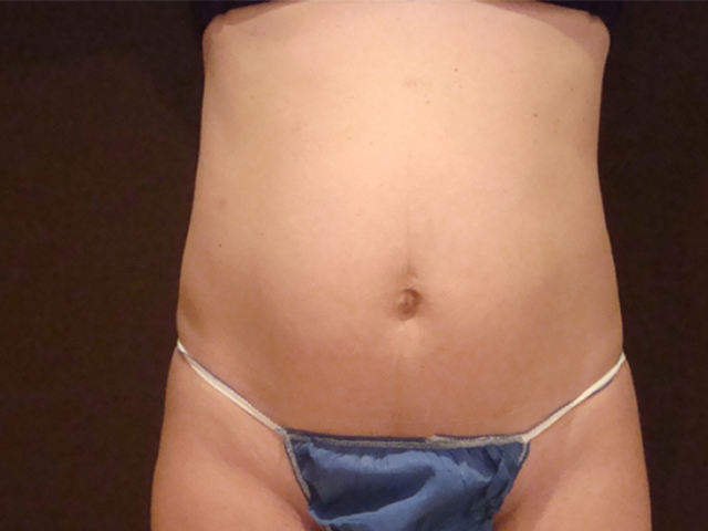 tummy tuck patient