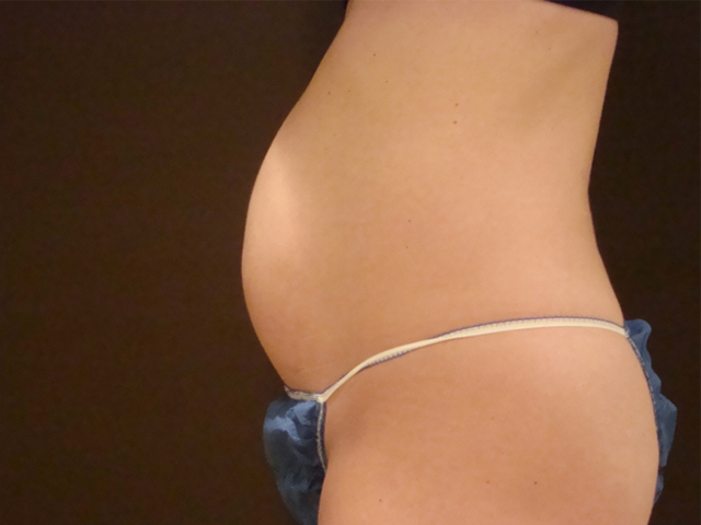 tummy tuck patient