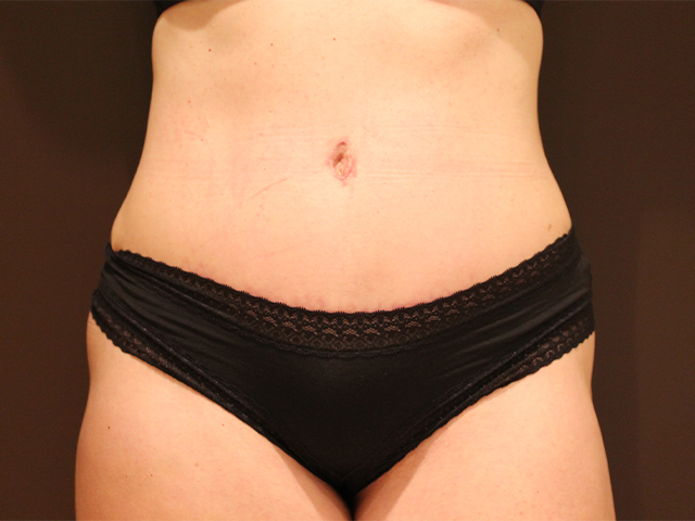 tummy tuck patient