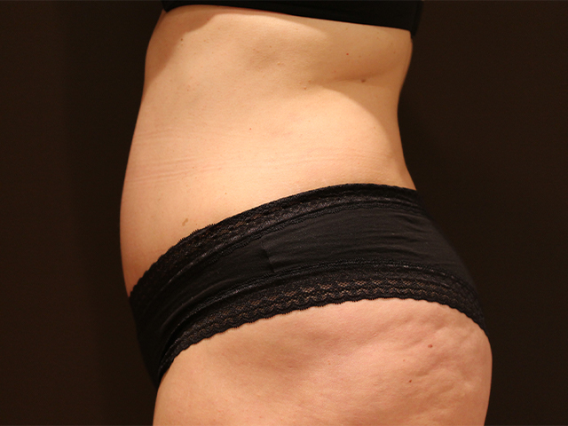 tummy tuck patient