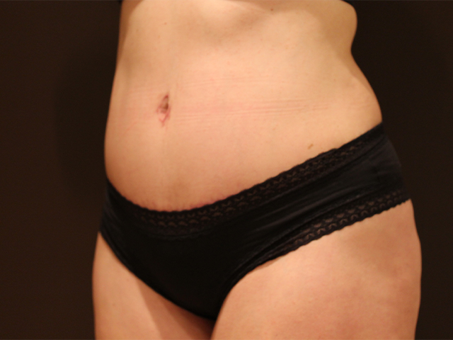 tummy tuck patient
