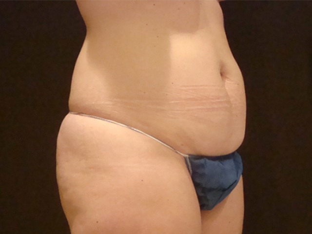 tummy tuck patient