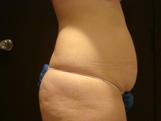tummy tuck patient