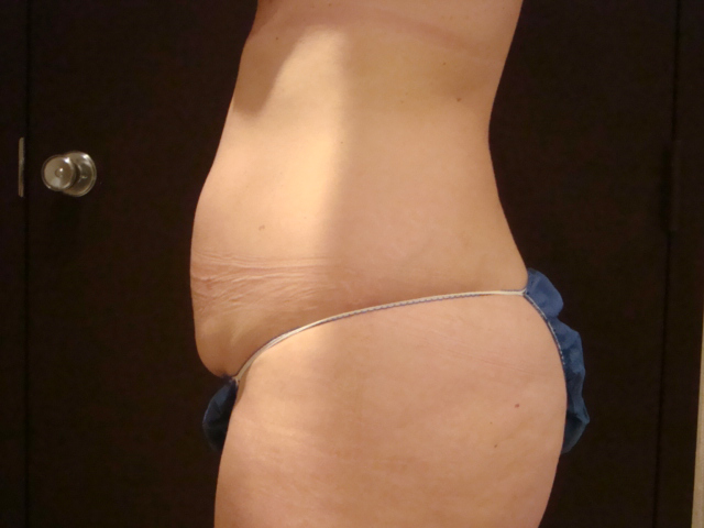 tummy tuck patient