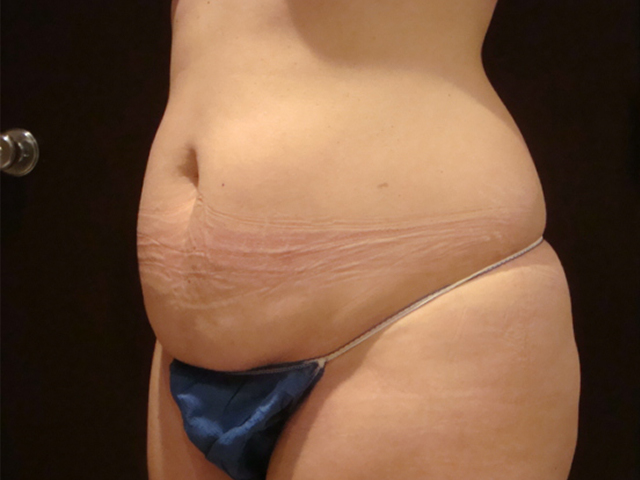 tummy tuck patient