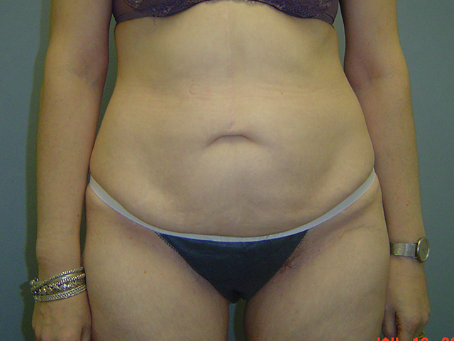tummy tuck patient