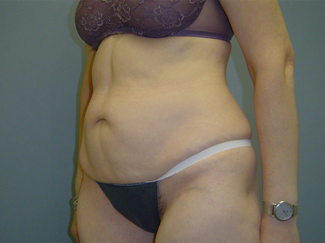 tummy tuck patient