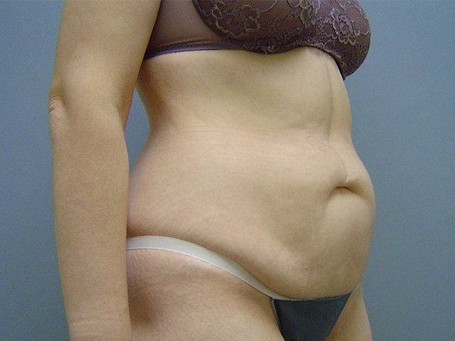 tummy tuck patient