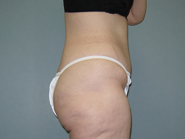 tummy tuck patient