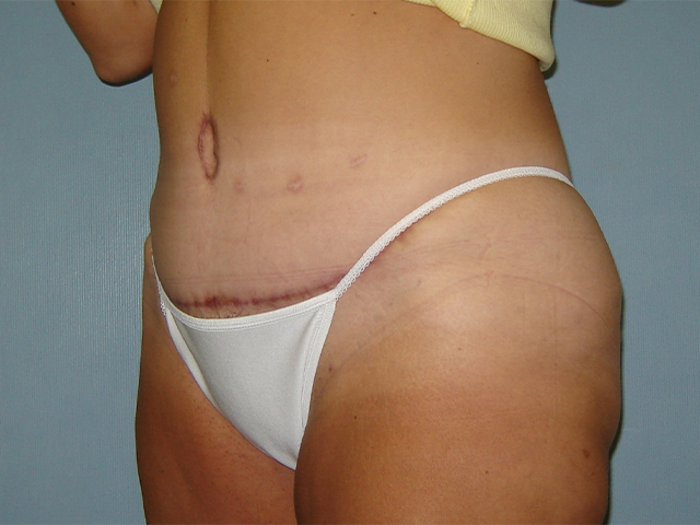tummy tuck patient
