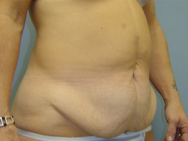 tummy tuck patient