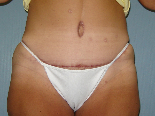 tummy tuck patient