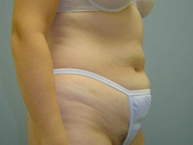 tummy tuck patient