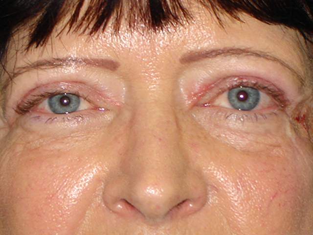 blepharoplasty patient