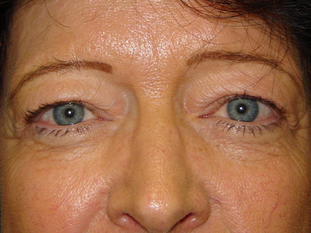blepharoplasty patient