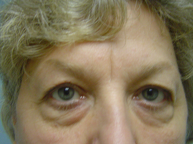 blepharoplasty patient