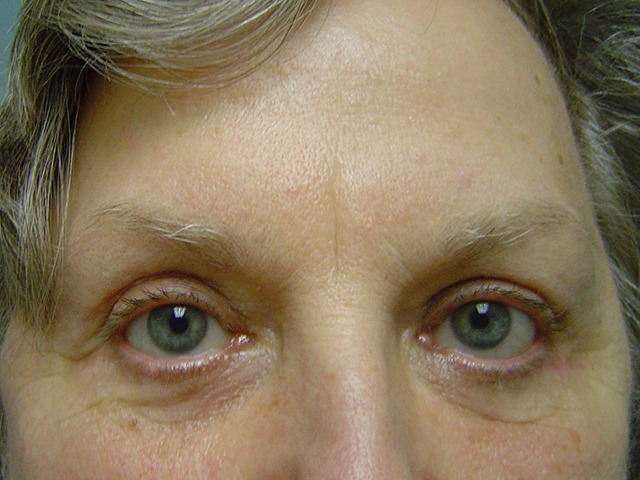 blepharoplasty patient