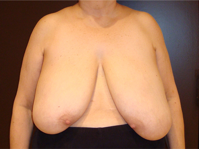 breast reduction patient