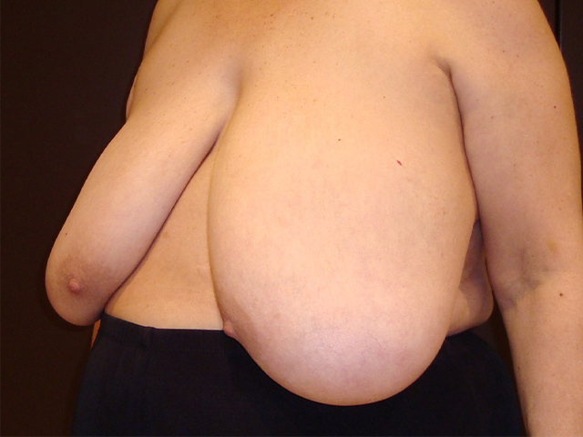 breast reduction patient