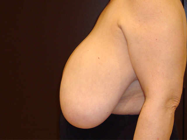 breast reduction patient