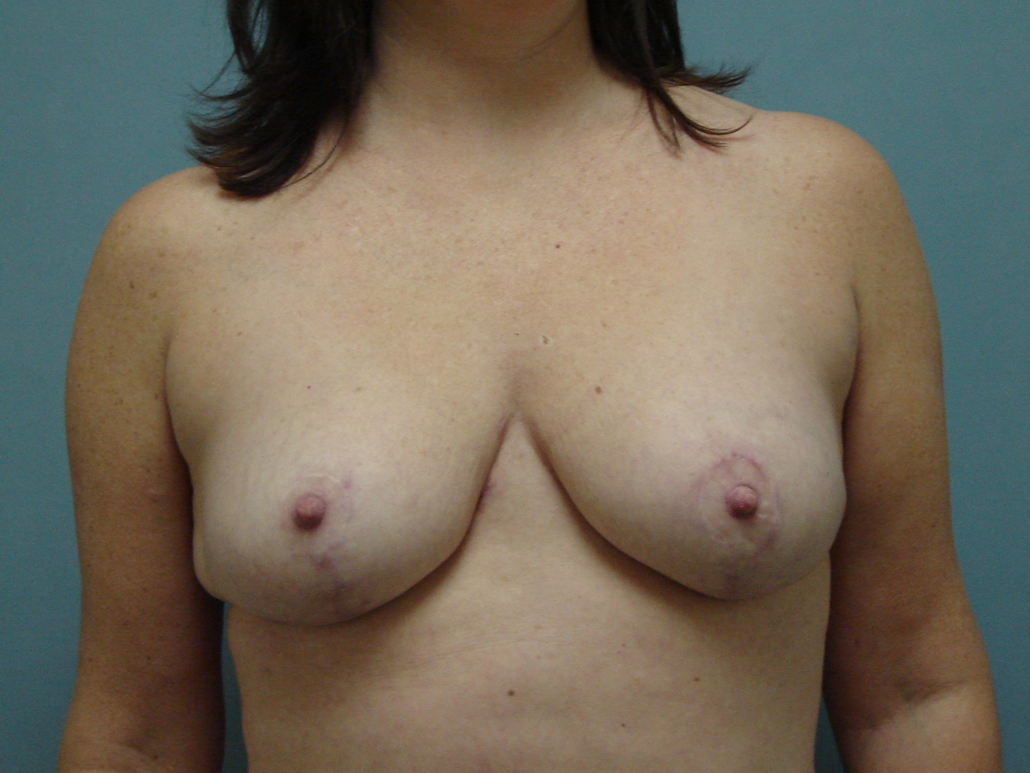 breast reduction patient