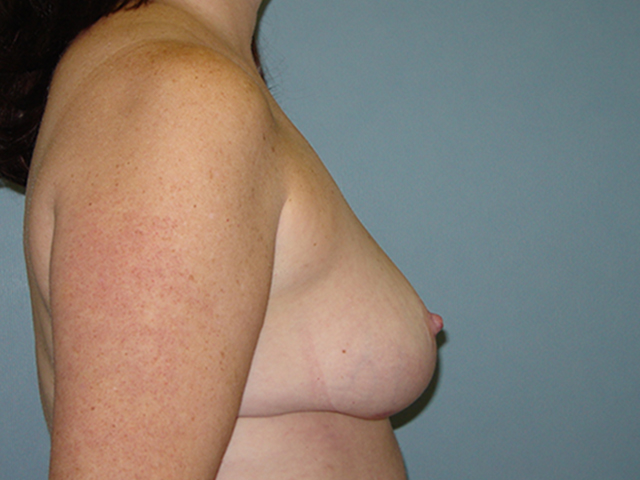 breast reduction patient