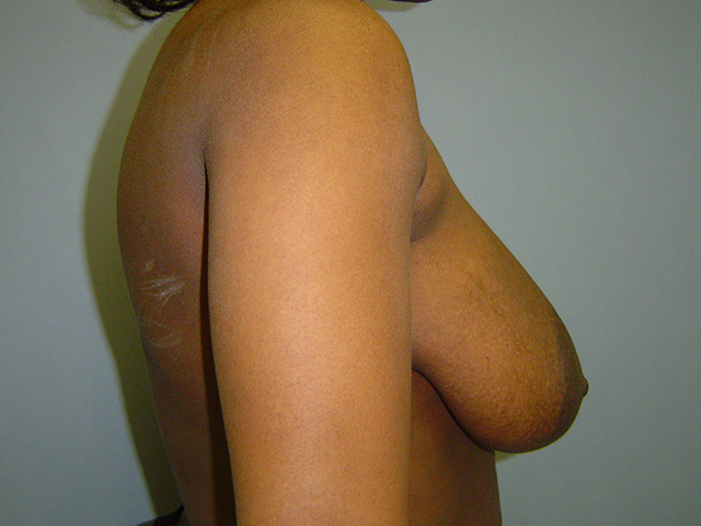 breast reduction patient