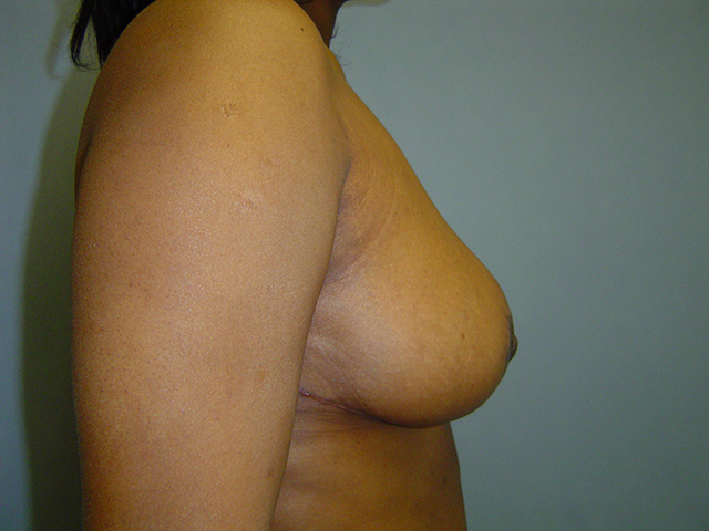 breast reduction patient